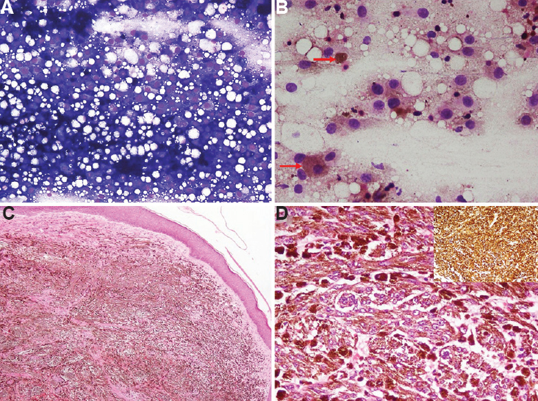 (A and B) FNA smears from cutaneous nodules showing sheets of pleomorphic cells with intracytoplasmic melanin pigment (red arrows) (May Grunwald Giemsa, ×200 and ×400 respectively). (C) Histopathology of skin nodule showing metastatic malignant melanoma with flattening of epidermis (H and E, ×100) and (D) Histopathology of anal lesion (H and E, ×400), (inset) Immunostain for HMB-45 (×400).